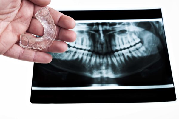 AdobeStock_48945962 (1) (1) Mouth X-Ray Pine Ridge Dental Zimmerman, Minnesota