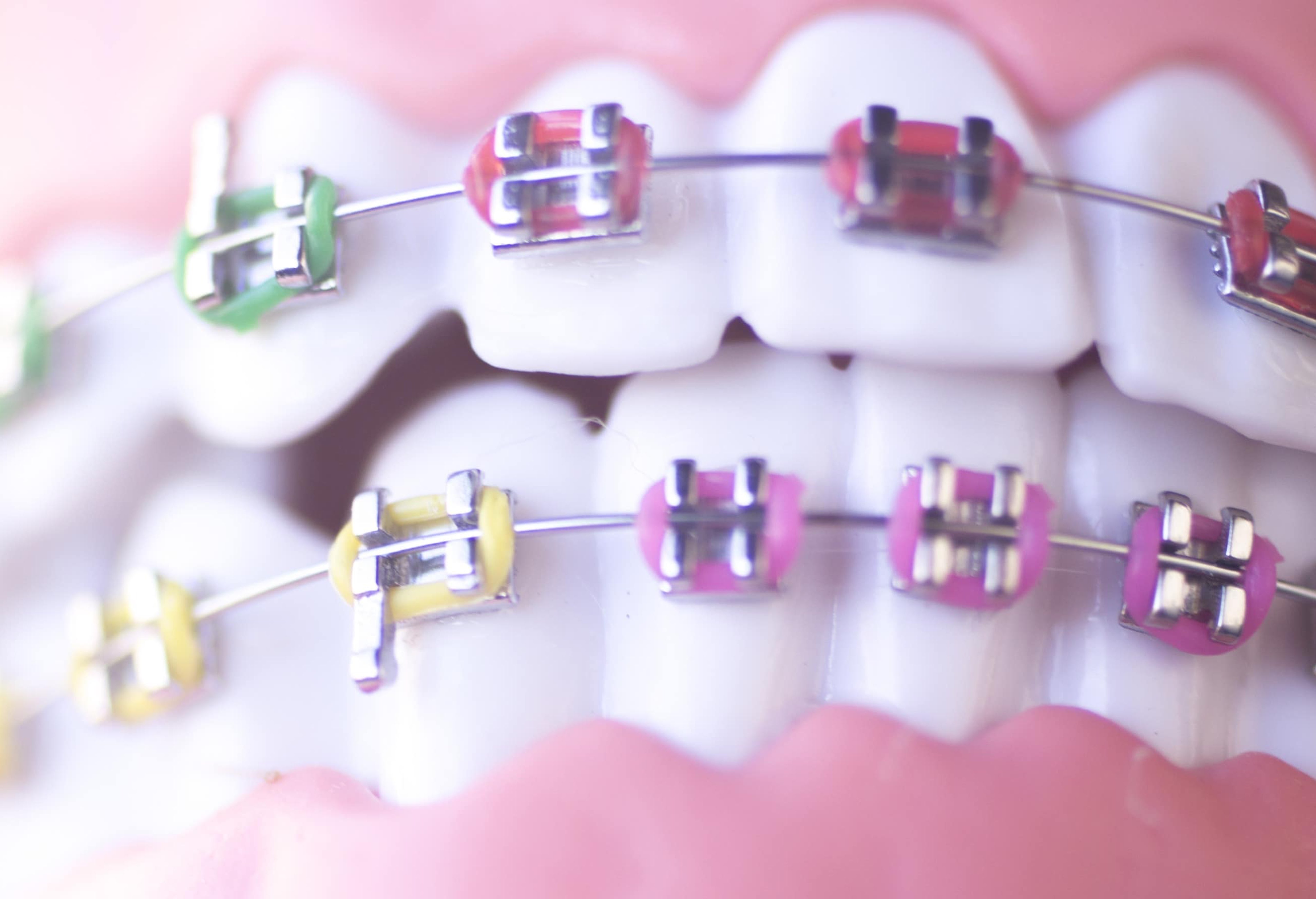 braces-orthodontist Pine Ridge Dental Zimmerman, Minnesota